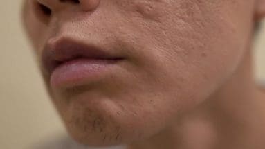 littekens gezicht acne