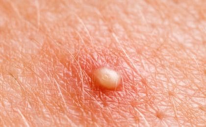 Comedonen, Whiteheads, Blackheads of gewoon mee-eter