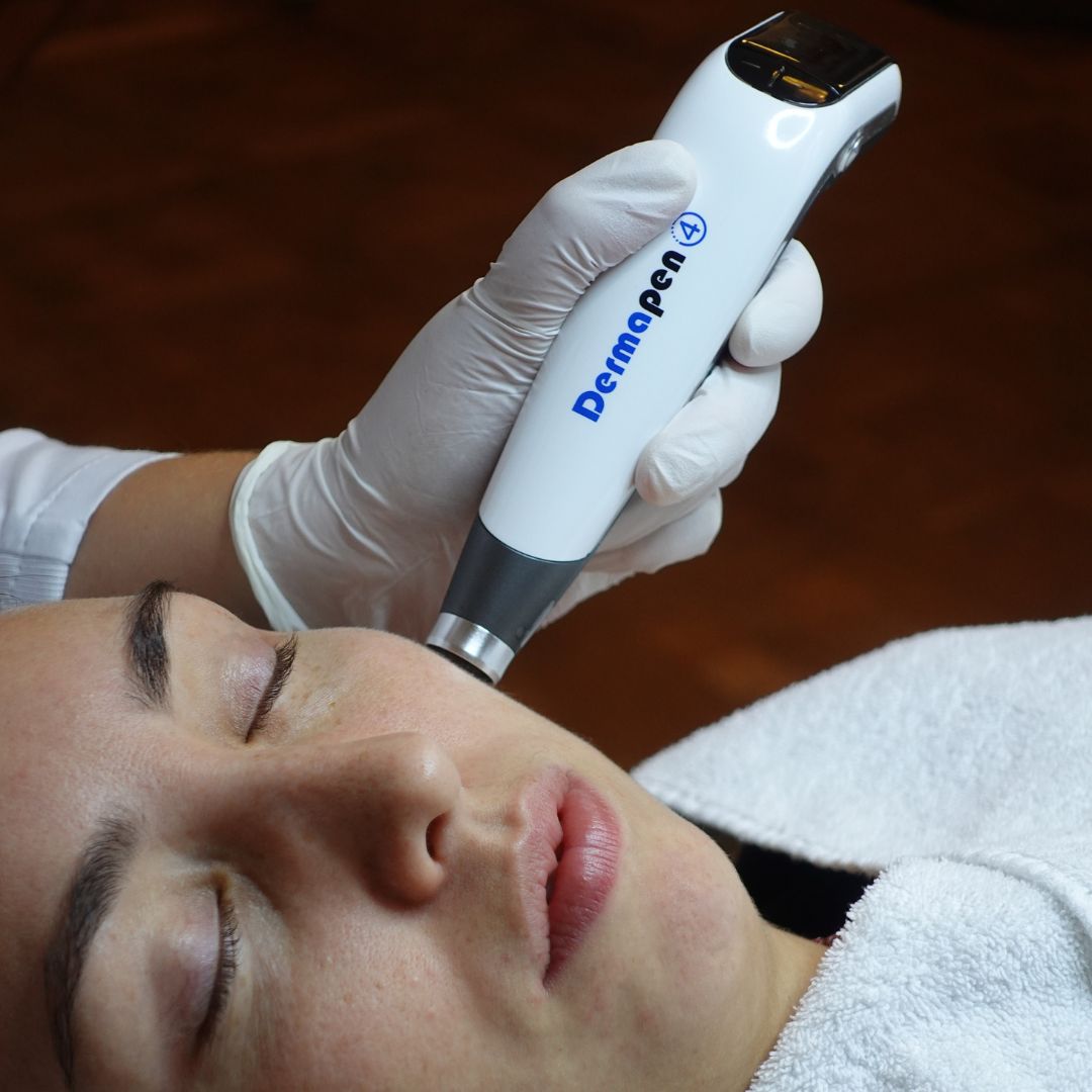 dermapen_huid dermapen_huid