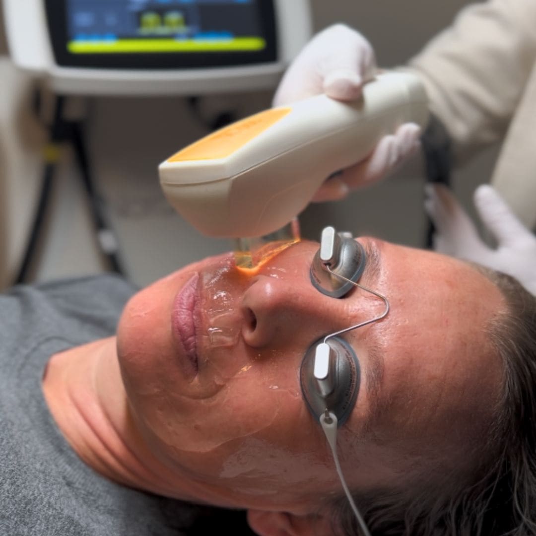IPL pigment
