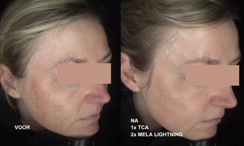 melasma_huid