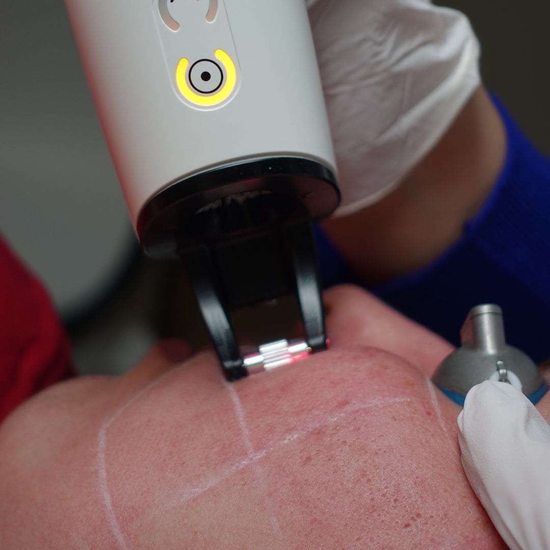 littenens verwijderen