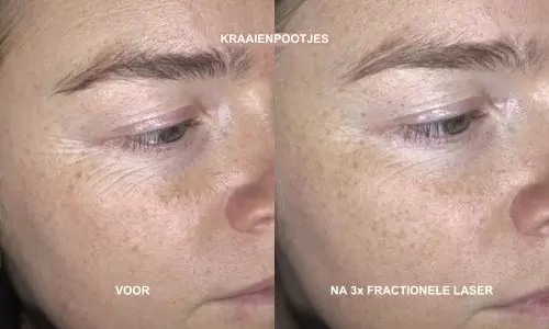kraaienpootjes