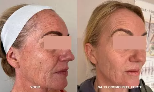 cosmo-peel-forte
