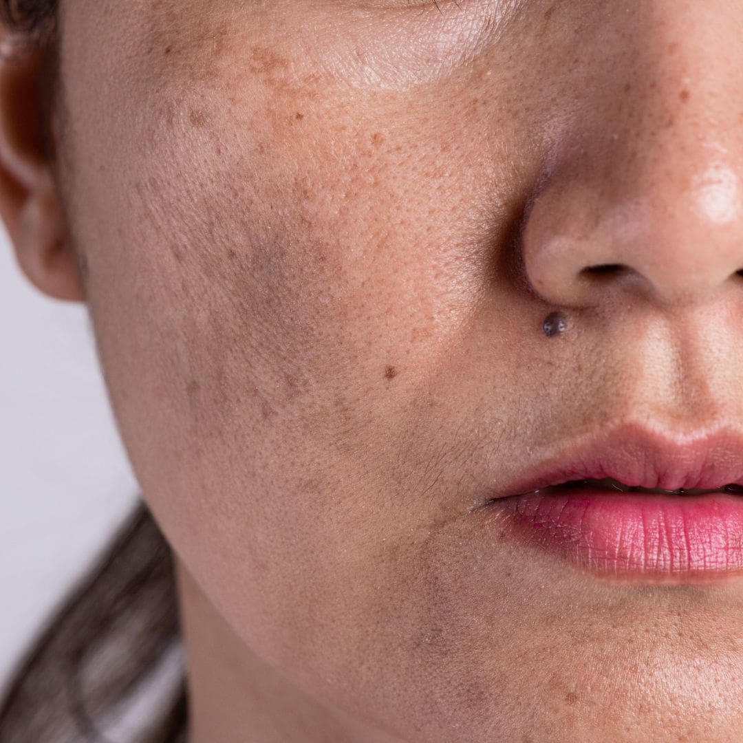 pigmenrvlekken en melasma