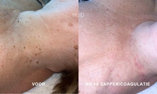 resultaat coagulatie_01
