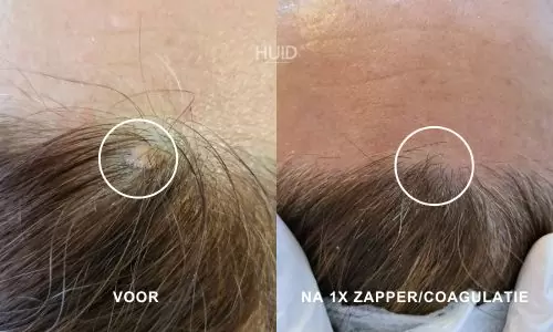 resultaat coagulatie_02