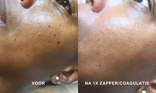 resultaat coagulatie_03