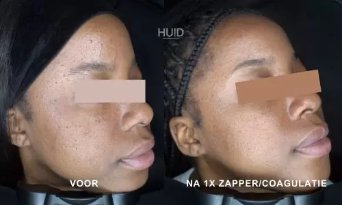 resultaat coagulatie_04