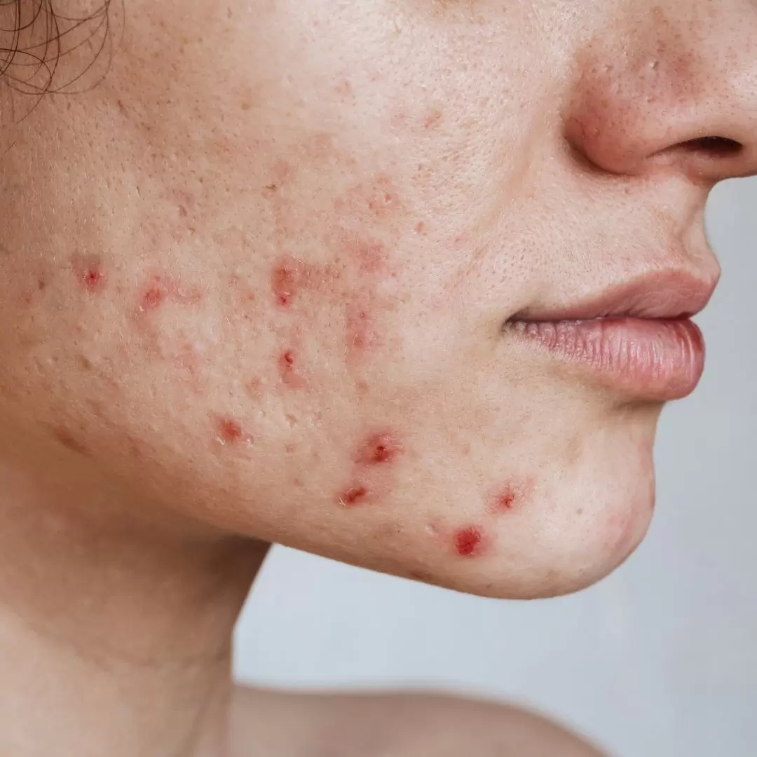 acne behandeling