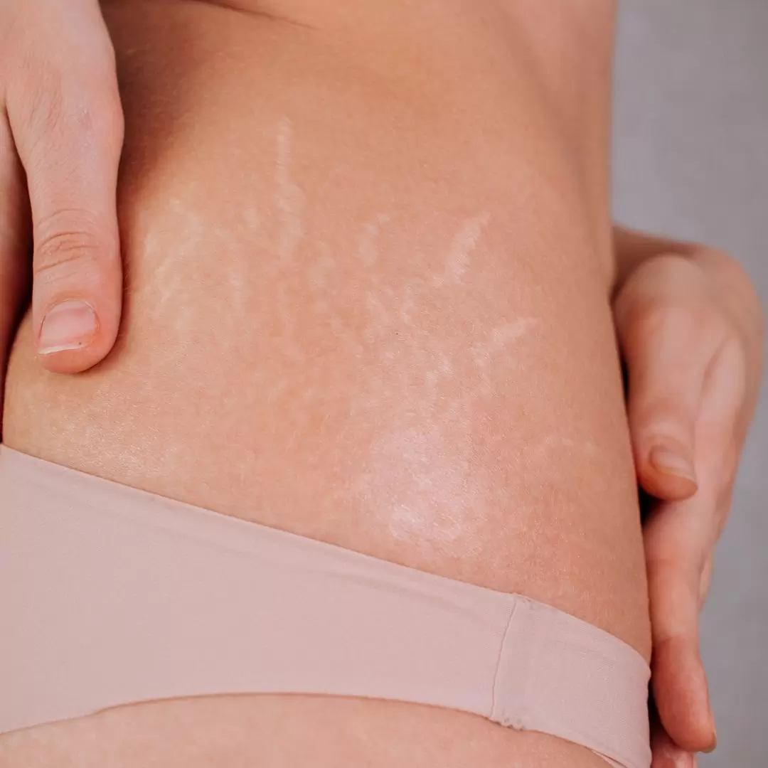 striae