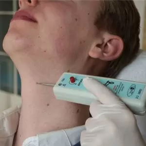 coagulatie zapper