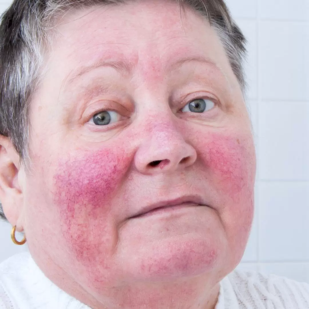 Erythemato-teleangi&euml;ctatische rosacea