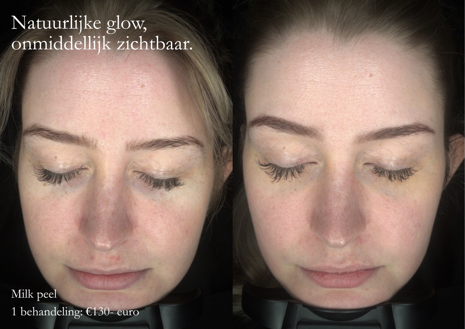 dermaceutitc_milkpeel