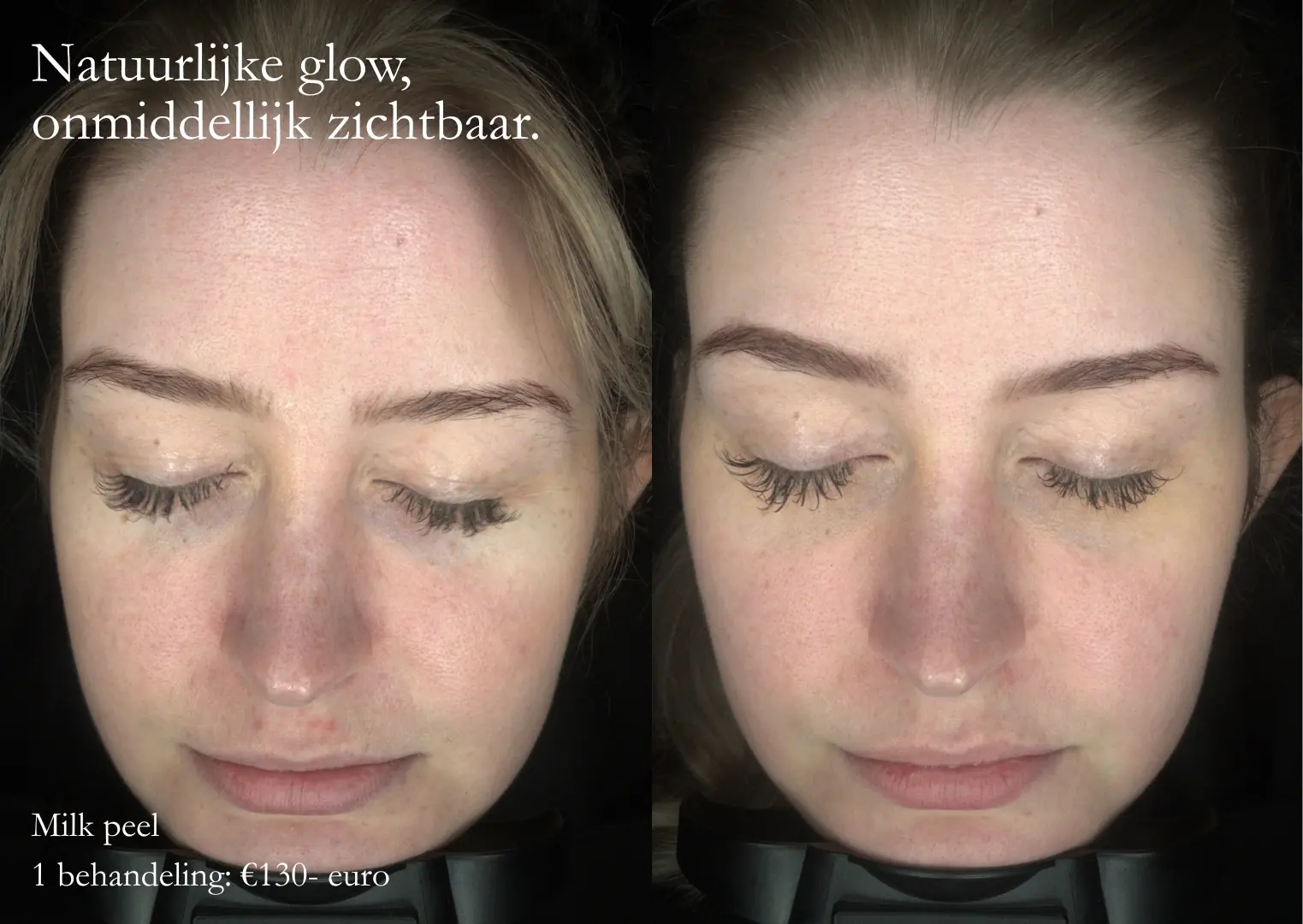 dermaceutitc_milkpeel