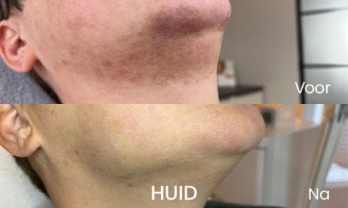 voor-en-na-website-2024_gezichtshaar